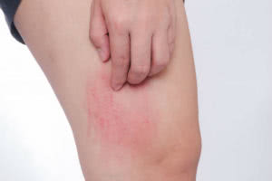Scratch Allergic Skin From Mosquito Bites